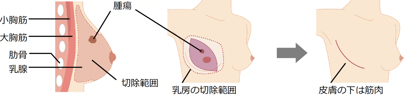 乳房切除術