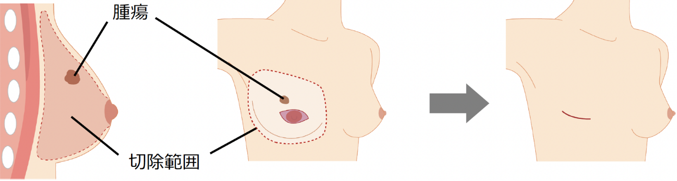 皮膚温存乳房切除術