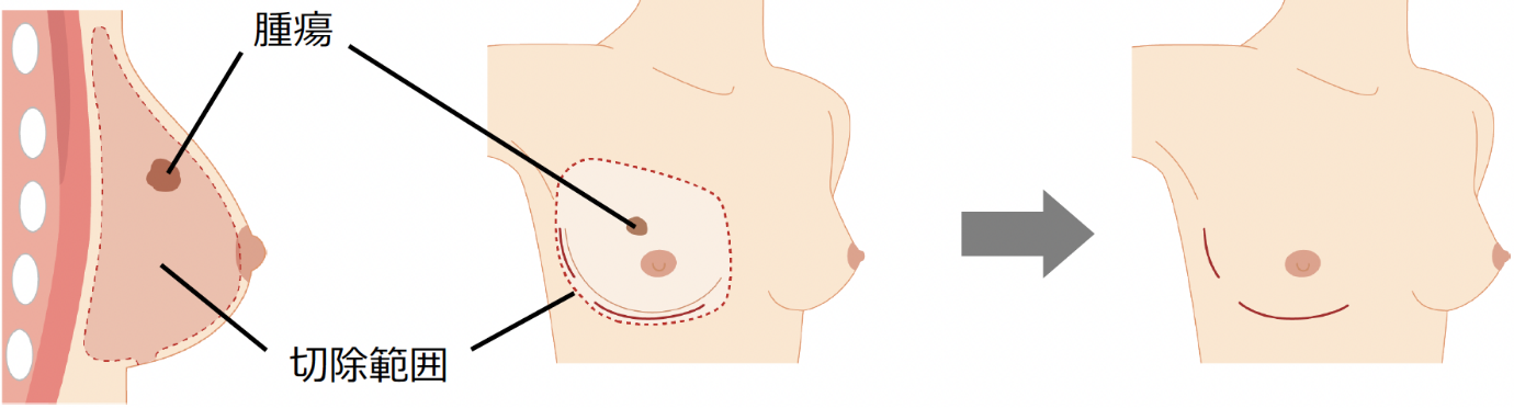 乳頭乳輪温存乳房切除術