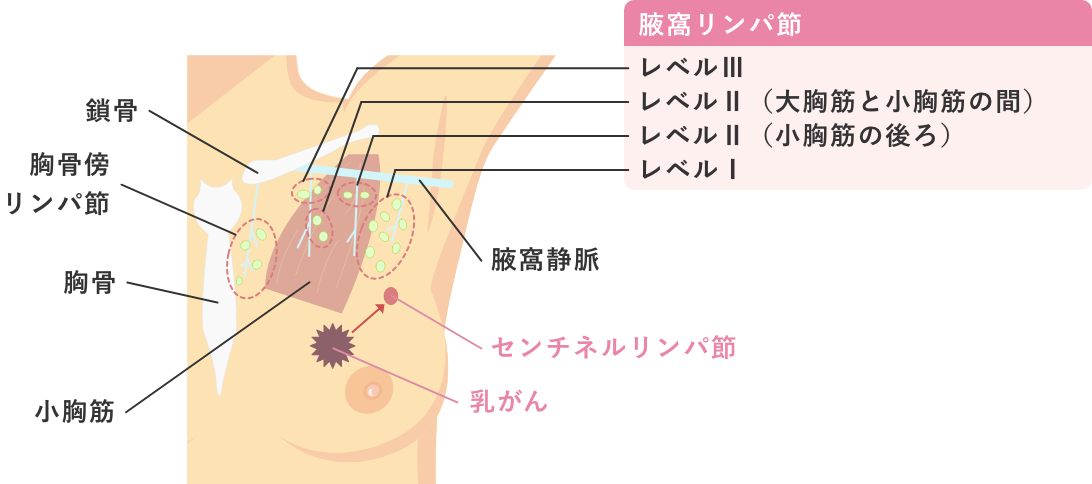 センチネルリンパ節生検 図