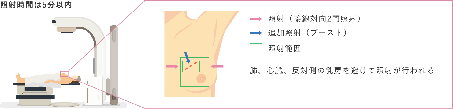 放射線療法 図