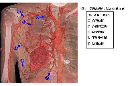 局所進行乳がんに対する治療法 聖マリアンナ医科大学