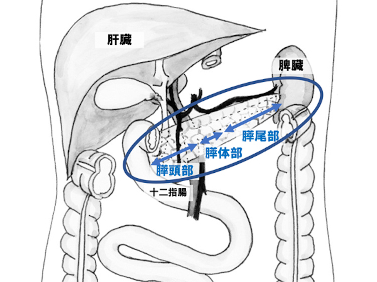 膵臓がんの図