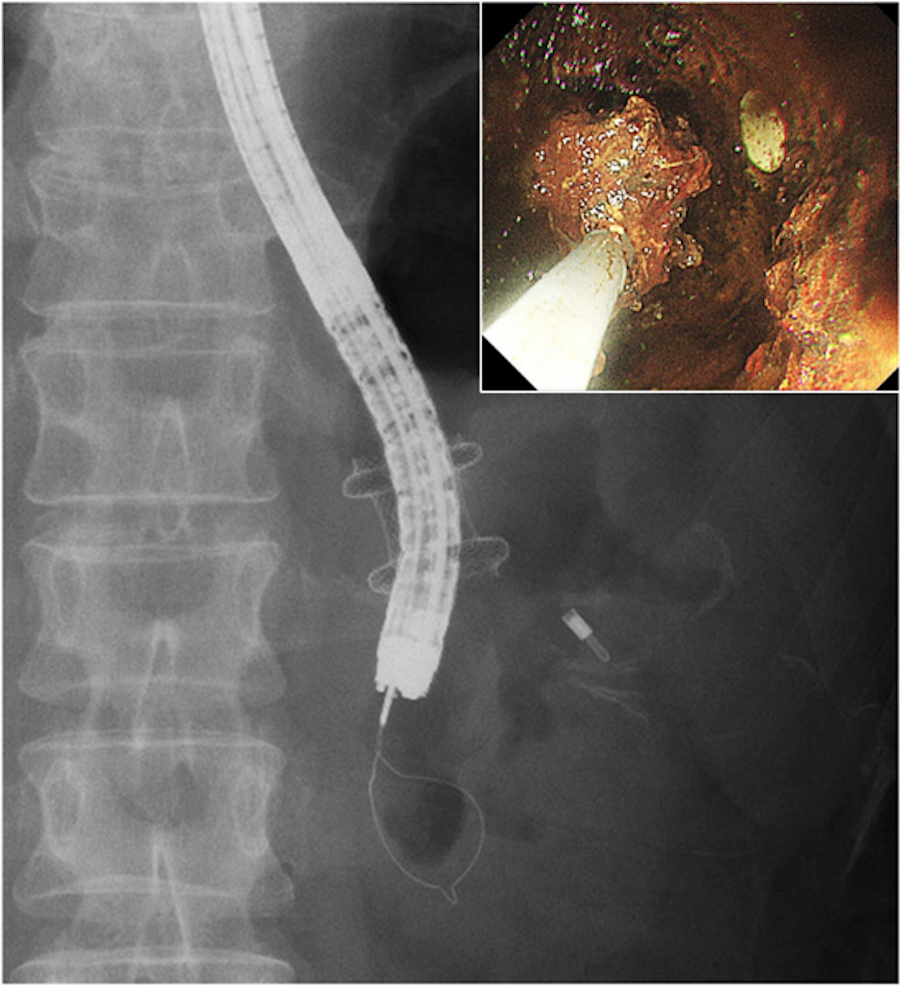 膵壊死に対する内視鏡的ネクロゼクトミー