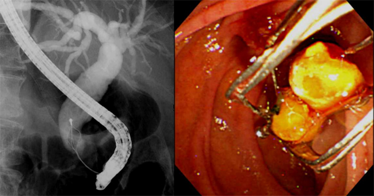 総胆管結石に対する内視鏡的結石除去術