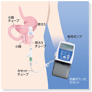 ポンプを使用して一定速度でレボドパ・カルビドパ製剤を投与