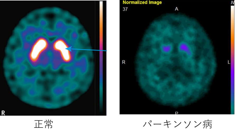 アルツハイマー病とレビー小体病の脳血流検査