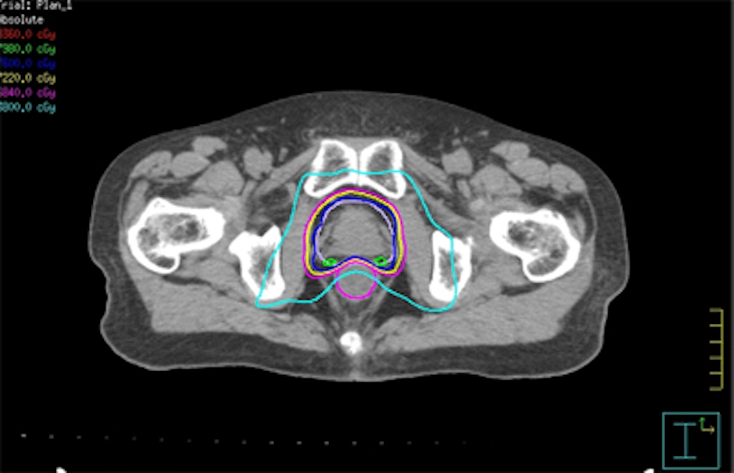前立腺癌に対する線量分布図