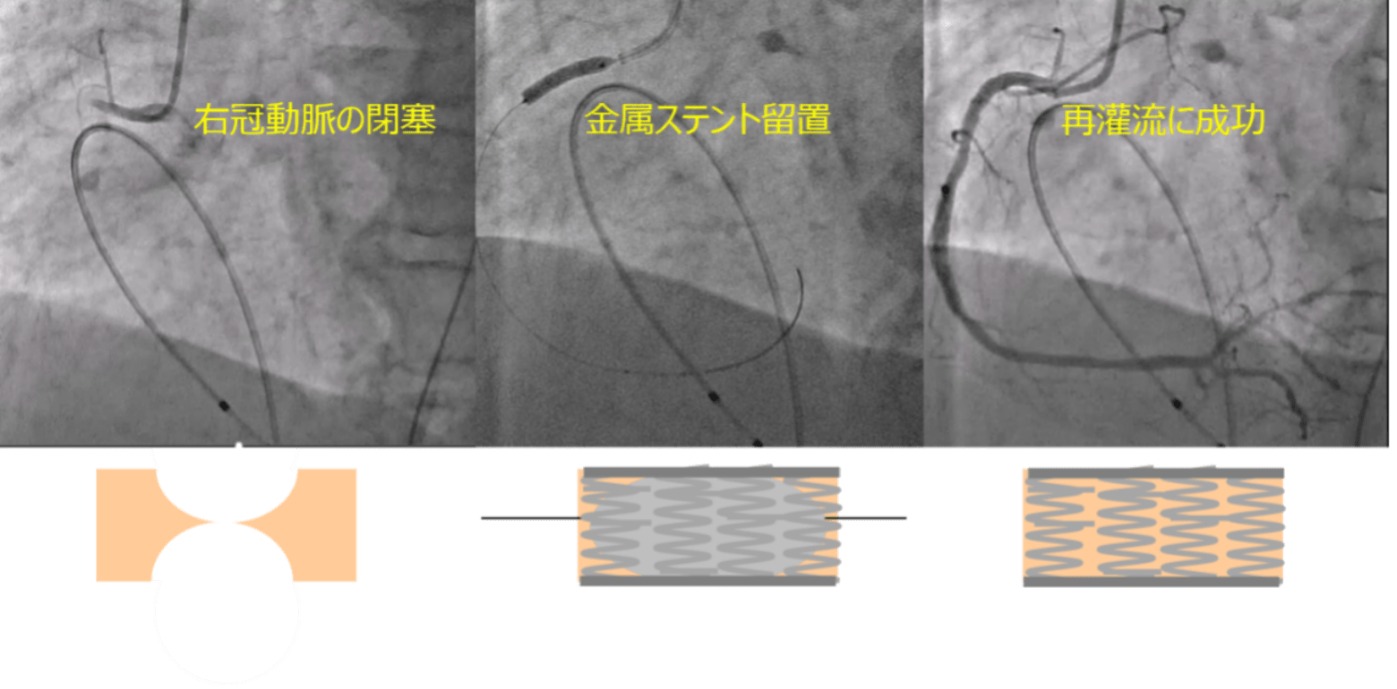 カテーテル治療