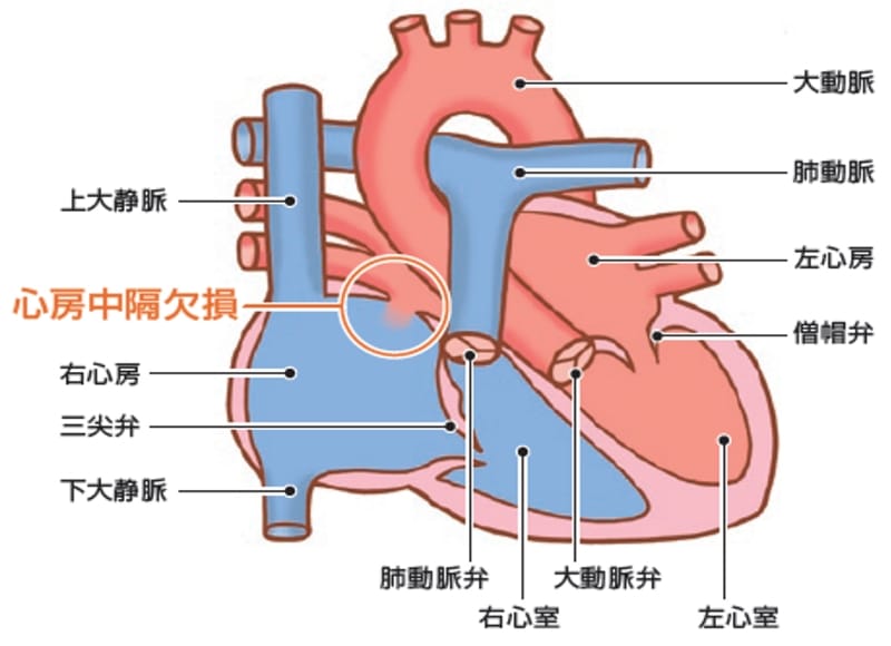 心房中隔欠損