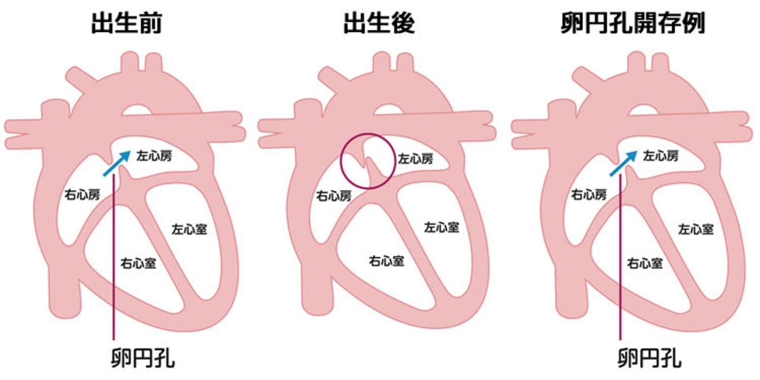 卵円孔開存の流れ