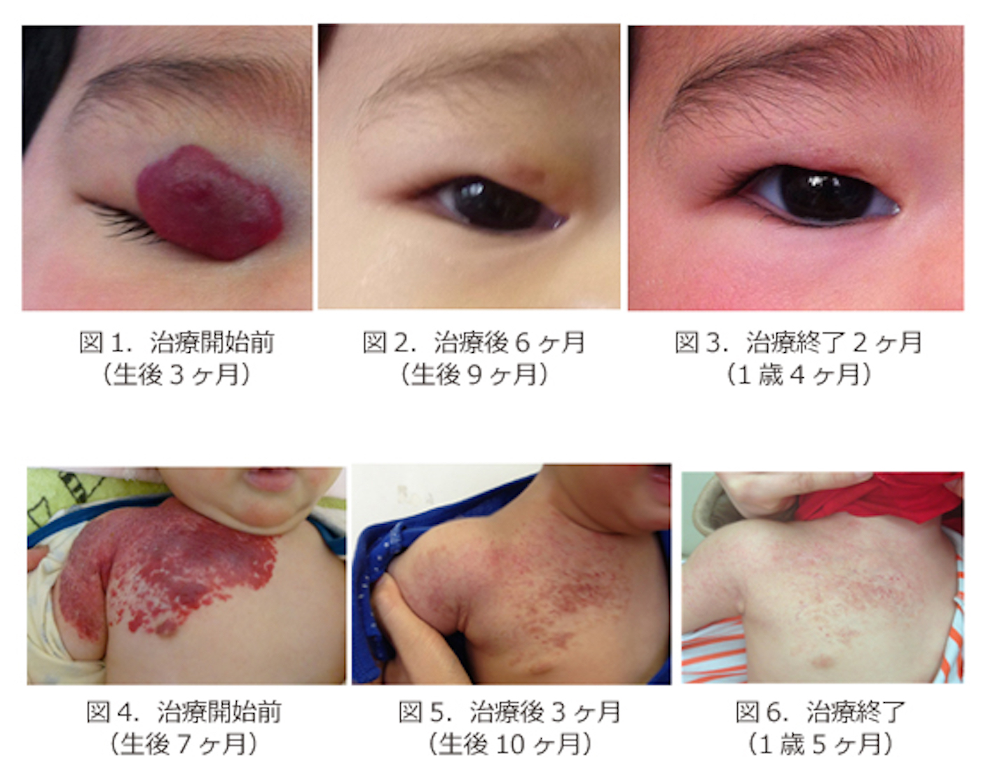 血管腫の兆候と症状