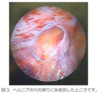 図3　ヘルニアの穴の周りに意図を回したところです。