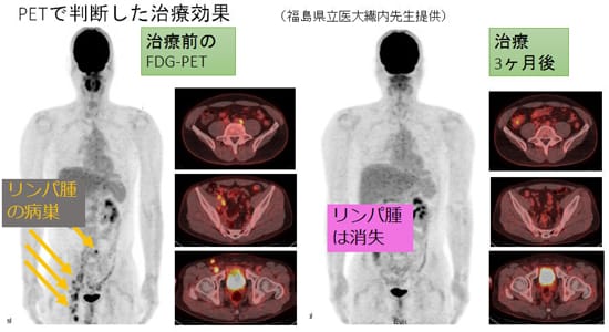 PETで判断した治療効果