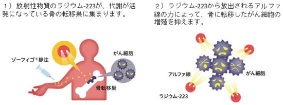 1)放射性物質のラジウム-223が、代謝が活発になっている骨の転移巣に集まります。2)ラジウム-223から放出されるアルファ線によって、骨に転移したがん細胞の増殖を抑えます。