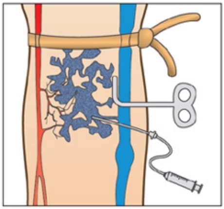 静脈奇形の硬化療法イラスト