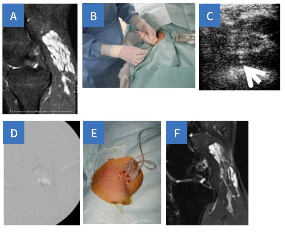 膝窩部静脈奇形のフォーム硬化療法写真