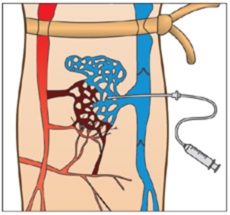 動静脈奇形の塞栓術イラスト
