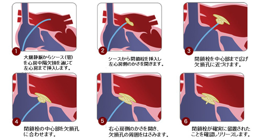 先天性心疾患に対するカテーテル治療を開始01