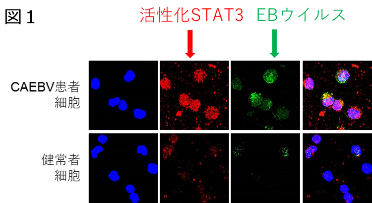 ウイルス eb 慢性活動性EBウイルス感染症の症状,原因と治療の病院を探す