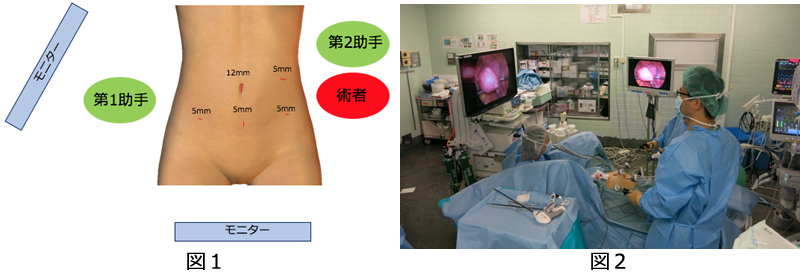 腹腔鏡子宮悪性腫瘍手術について01