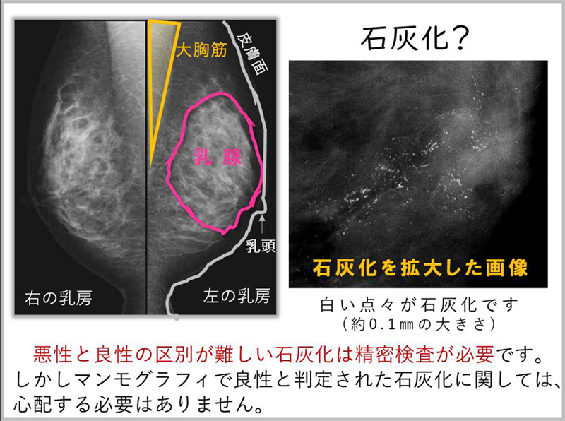 化 マンモグラフィー 石灰