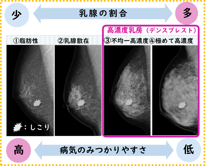 乳がん検診の疑問を解決しませんか Vol 4 Marianna Today 学校法人聖マリアンナ医科大学