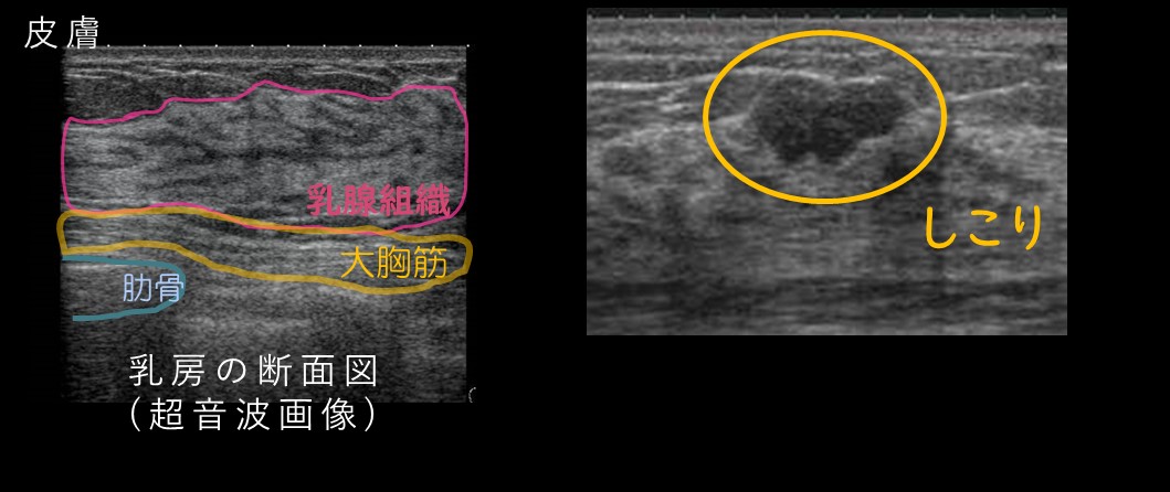 乳がん検診の疑問を解決しませんか Vol 5 Marianna Today 学校法人聖マリアンナ医科大学